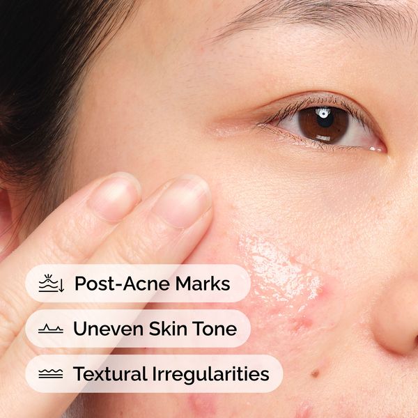 Post-Acne Marks Reduction with Aloe 2% + NAG 2% Solution - Image 2